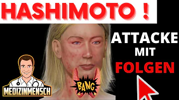 Hat Hashimoto Einfluss auf die Augen?