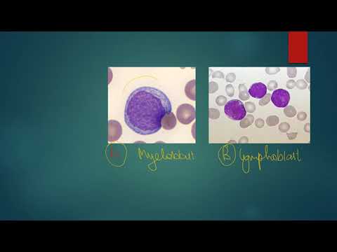 Myeloblast vs Lymphoblast mnemonic