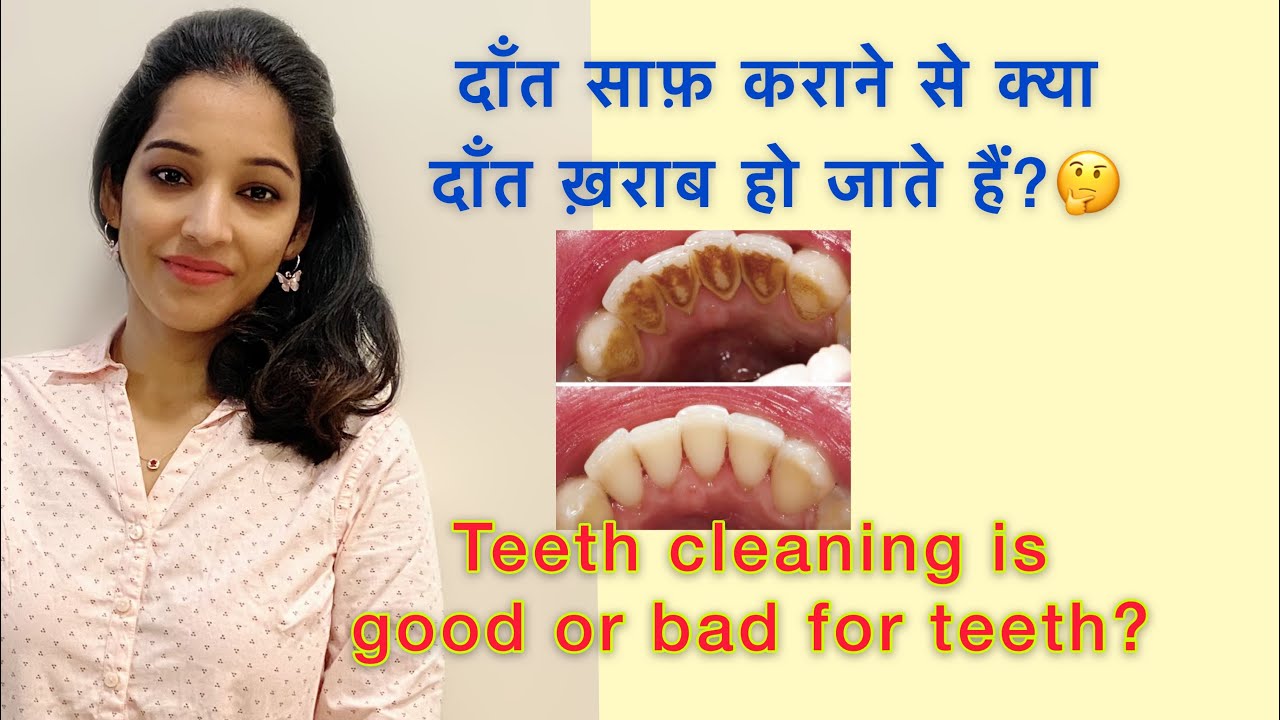 Teeth cleaning good or bad for teethमशीन से दाँत साफ़ कराने के फ़ायदे