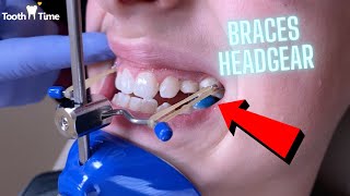Headgear Braces - Orthodontic Appliance - 11 Year old patient - Tooth Time New Braunfels Texas