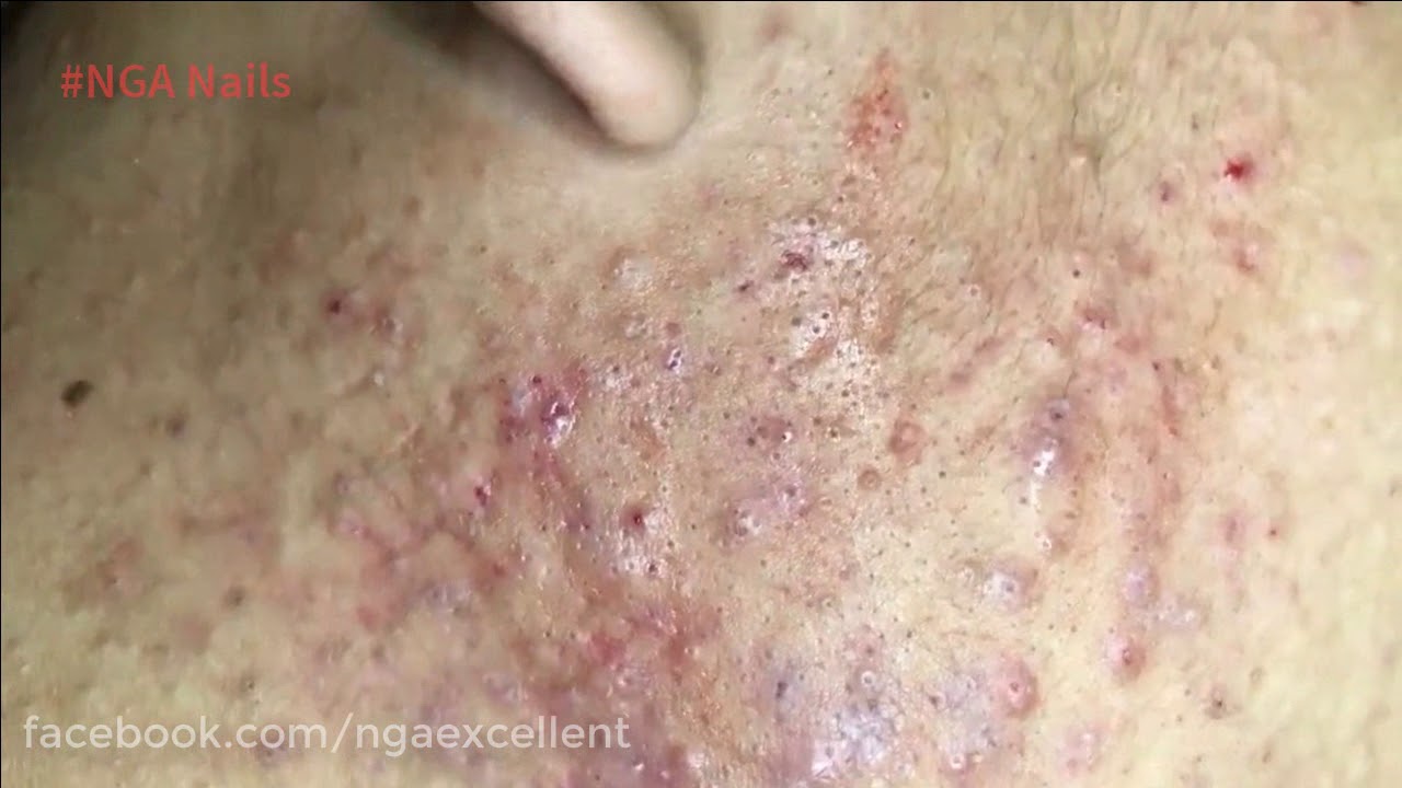 Blackhead Removal videos 2017 YouTube