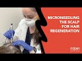 MicroNeedling the Scalp for Hair Regeneration