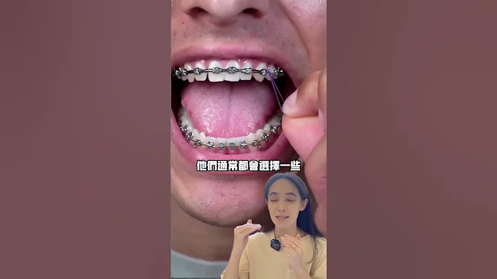 如何讓你的牙套更有型#牙齒矯正橡皮筋 - 天天要聞