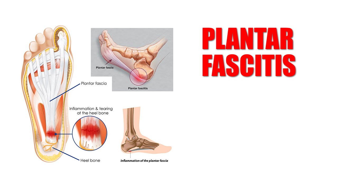 Tens Unit Placement Chart For Plantar Fasciitis