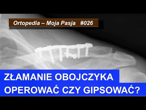 Wideo: Złamanie Obojczyka Z Przemieszczeniem I Bez - Leczenie, Rehabilitacja, Rodzaje Bandażowania