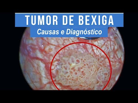 Vídeo: Tumor Benigno Da Bexiga: Tipos Não Cancerosos De Tumor Da Bexiga