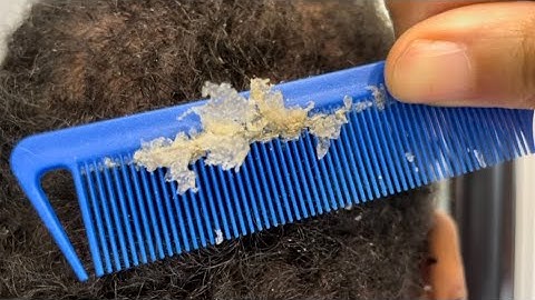 Another satisfying scratch/scalp ASMR #psoriasis #asmr #dandruffremoval