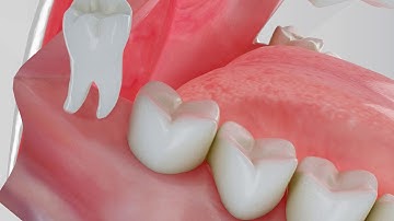 Animated Videos About Tooth Extraction   Wisdom Tooth