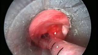 Endoscopic treatment of trachea-left main bronchus anastomotic stenosis