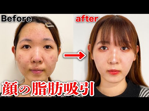 【整形】顔の脂肪吸引！施術前と3ヶ月後のビフォーアフター【小顔】