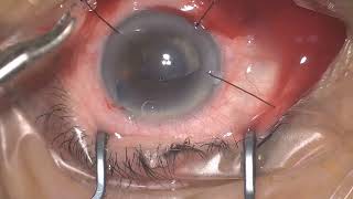 Inserting Iris Hook Small pupil