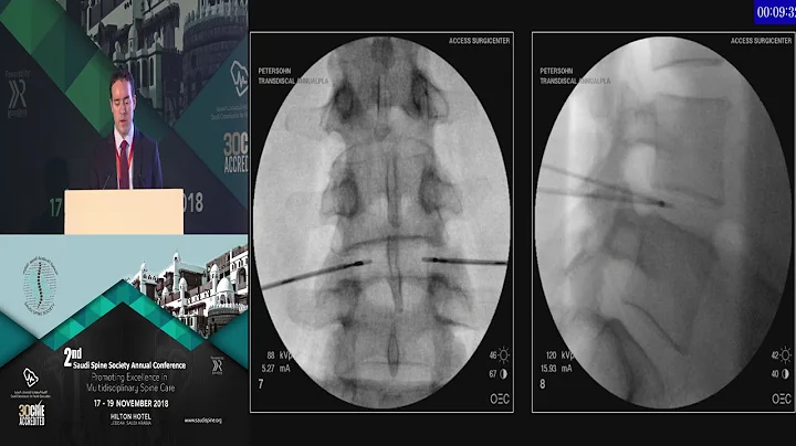 Intradiscal Biacuplasty for Discogenic Low Back Pa...