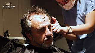 Hair Transplant Journey Well World Aesthetic Longevity Clinic