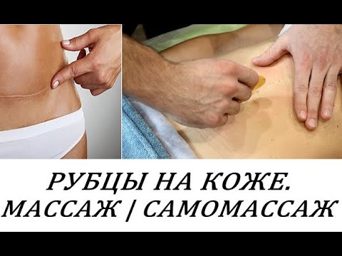 РУБЦЫ НА КОЖЕ. МЕТОДИКА МАССАЖА