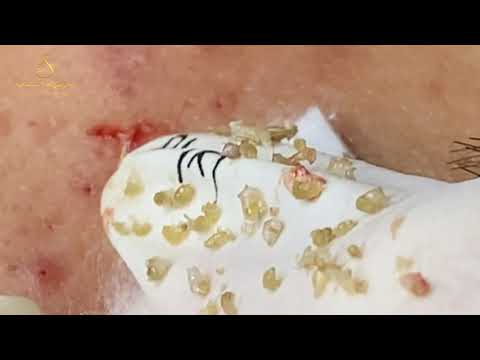 Loan Nguyen Acne Treatment (#166)