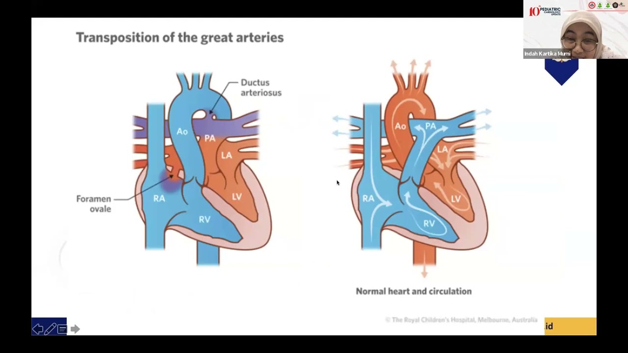 Skrining, Diagnosis dan Tatalaksana PJB pada Neonatus - dr. Indah Kartika Murni, M.Kes,Ph.D,Sp.A (K)