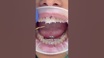 Smile Transformation With Composite Bonding Veneers | Before And After