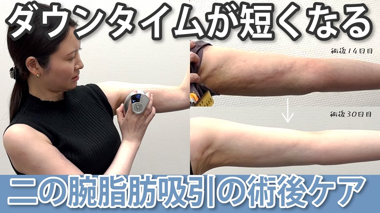 術後のボコつき気になる方必見】快適なダウンタイムの過ごし方を教え