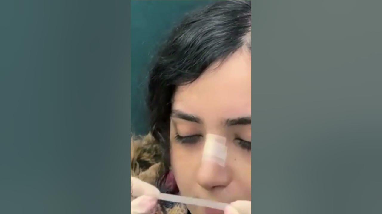 How to Tape the Nose After a Rhinoplasty YouTube
