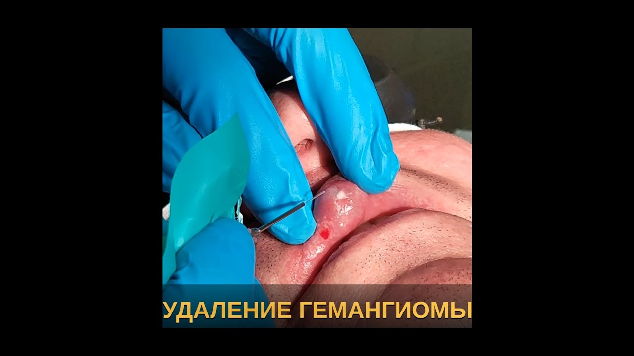 Удаление гемангиомы на верхней губе