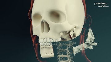PIEZOSURGERY® | Mandibular Reconstruction Animation