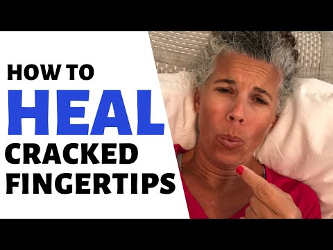 HOW TO HEAL CRACKED FINGERTIPS ~ HOME REMEDY