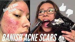 BANISH ACNE SCARS Review + Photo Progress