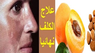 و اخيرا اقوى خلطة لإزالة الكلف والبقع الداكنة نهائيا من الوجه/ماسك لوزالمشمش