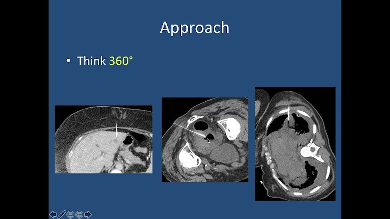Percutenous drainage and biopsy