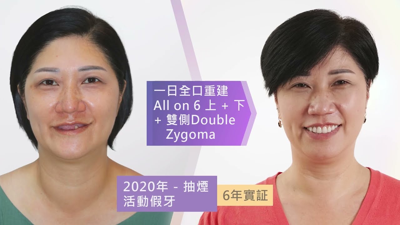 好牙齒能讓你年輕幾歲?|全口重建患者的術前術後紀錄 縮圖