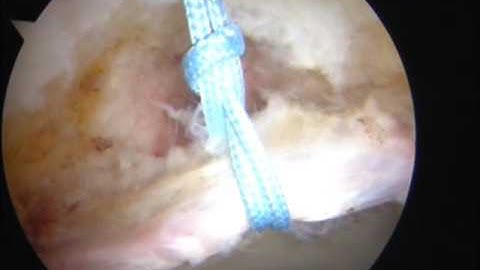 Bioraptor Knotless Hip