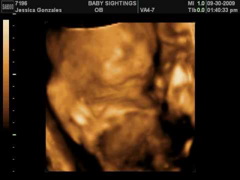 Isaiah Angel Salinas 3D Ultrasound 2