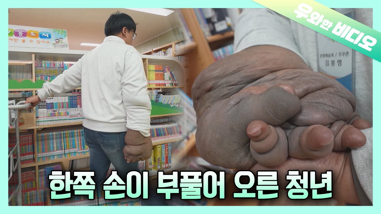 Особая история человека, чья рука распухла из-за фибромы