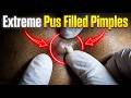 Extreme Pus Filled Pimples