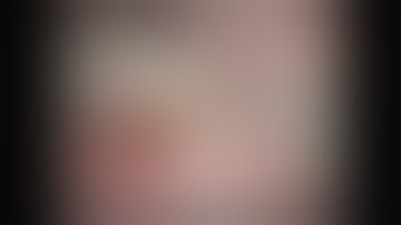 ROBOTIC RIGHT HEPATECTOMY WITH CHOLECYSTECTOMY FOR HEPATOCELLULAR CARCINOMA