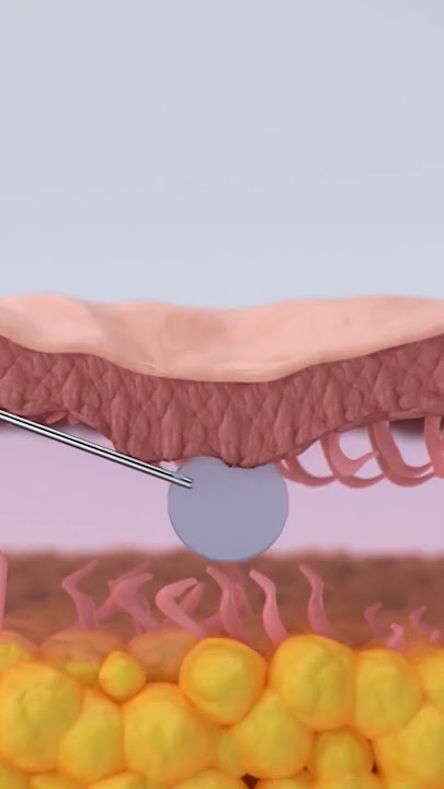 APA ITU SUBSISI SCAR? APA AJA SIH MANFAAT TREATMENT SUBSISI SCAR. SIMAK VIDEONYA YUK
