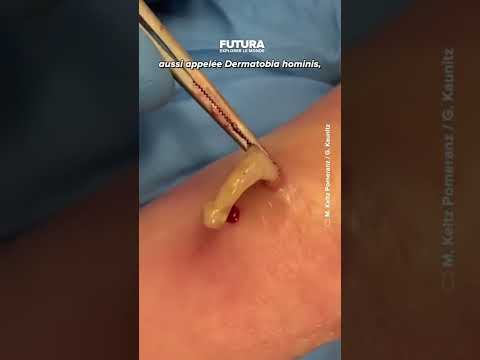 Cette femme abritait 6 larves de la mouche humaine sous sa peau après un voyage en Colombie ! 🐛🇨🇴