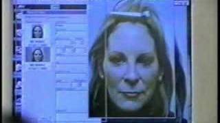 Browlift part 1 by Dr. Edwin Williams of Latham NY