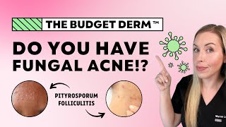 5 Signs You Have Fungal Acne…NOT Regular Acne! | The Budget Derm Explains