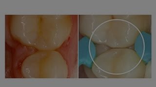 How To Get Tight Contact Creation During a Class II Dental Restoration | Dentsply Sirona