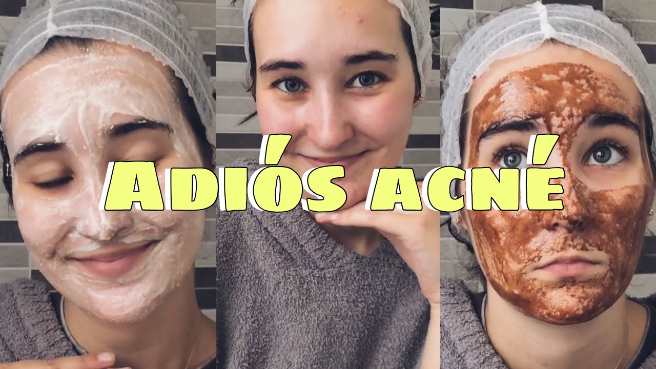 Dieta para eliminar el acne en 3 dias