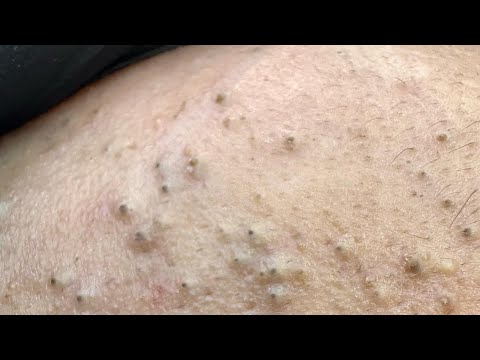 Deep Pores Covered in Thick Hard Skin & Corns | Professional Skincare Routine