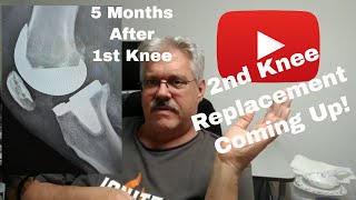 Getting My 2nd Knee Replaced. Going for Cyborg Status