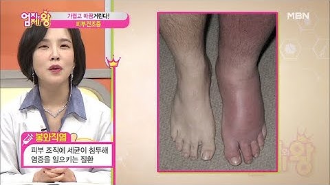 건강의 적신호! 피부 괴사와 패혈증까지 부르는 위험한 피부건조증