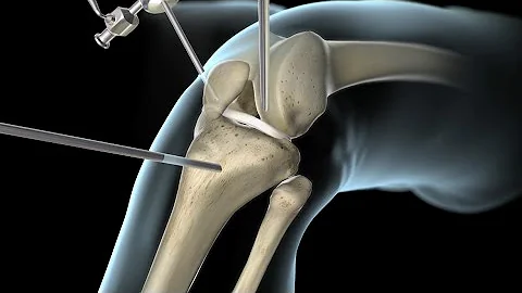 ¿Qué hacen los médicos en caso de rotura de ligamentos?