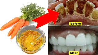 Home remedy for teeth whitening,In 2 minutes,yellow will make dirty teeth white like pearl and shiny