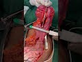 Stapled FEEA after Left Hemicolectomy