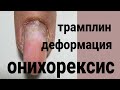 САМЫЕ СЛОЖНЫЕ  руки / коррекция трамплинов / деформация всех ногтей / онихорексис  расщепление нп