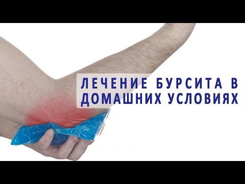 Лечение бурсита в домашних условиях