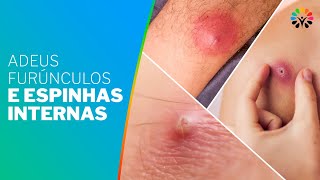 Como Se Livrar De Furúnculos E Espinhas Internas?